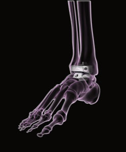 Ankle Joint Replacement
