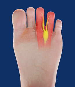 Morton's Neuroma