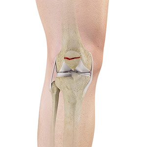 Patella Fracture Sydney, NSW | Knee Deformity & Fracture Randwick