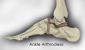 Ankle Arthrodesis