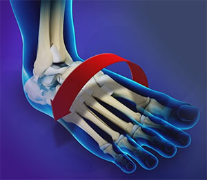 Ankle Instability