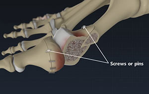 Bunion Surgery