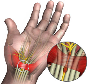 Carpal tunnel release Information