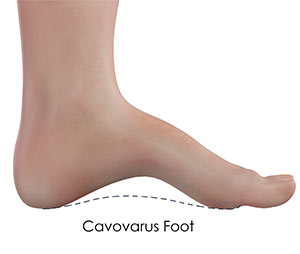 Cavovarus Foot Correction