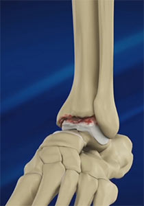 Foot and Ankle Osteoarthritis