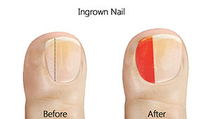 Ingrown Toenail