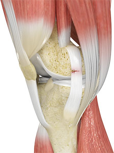 Ligament Injuries Sydney, NSW, ACL, MCL, PCL Tear Randwick