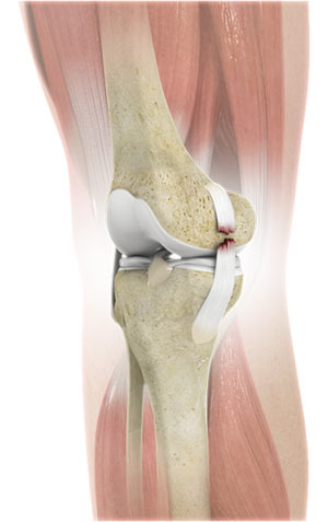 Medial Collateral Ligament (MCL)