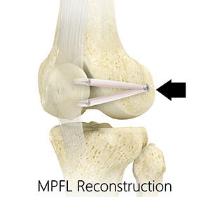 Medial Patellofemoral Ligament Reconstruction