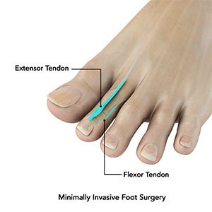 Minimally Invasive Foot Surgery