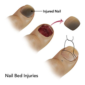 Nail bed in Fungal Nail