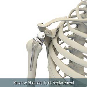 Minimally Invasive Total Hip Replacement