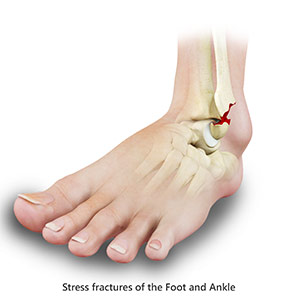 Stress Fracture of the Foot