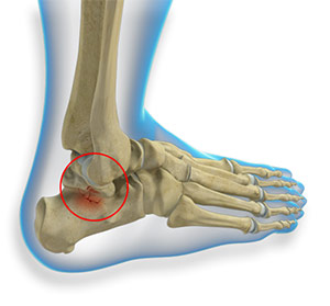 Talus Fractures
