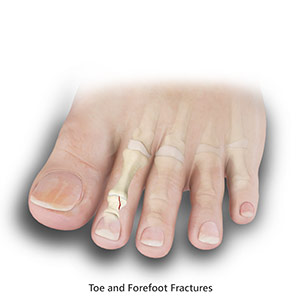 Toe and Forefoot Fractures