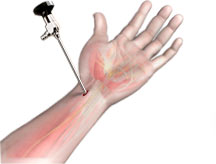 Wrist Arthroscopy