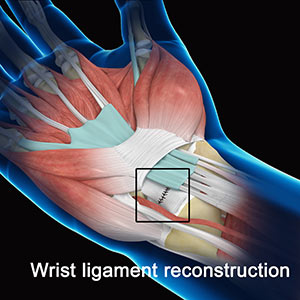Wrist Ligament Reconstruction