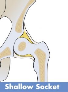 Periacetabular  Osteotomy