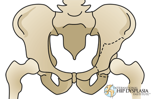 Periacetabular  Osteotomy