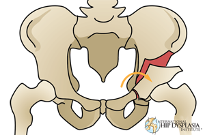 Periacetabular  Osteotomy