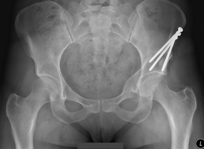 Periacetabular  Osteotomy