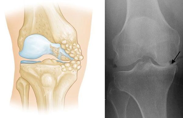 Unicompartmental Knee Replacement