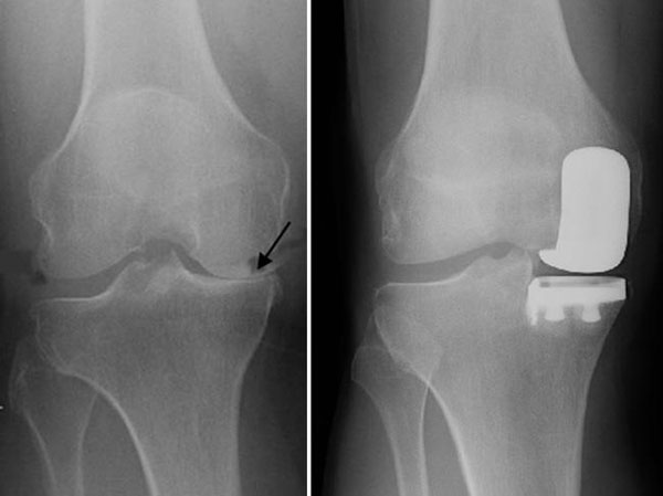 Unicompartmental Knee Replacement